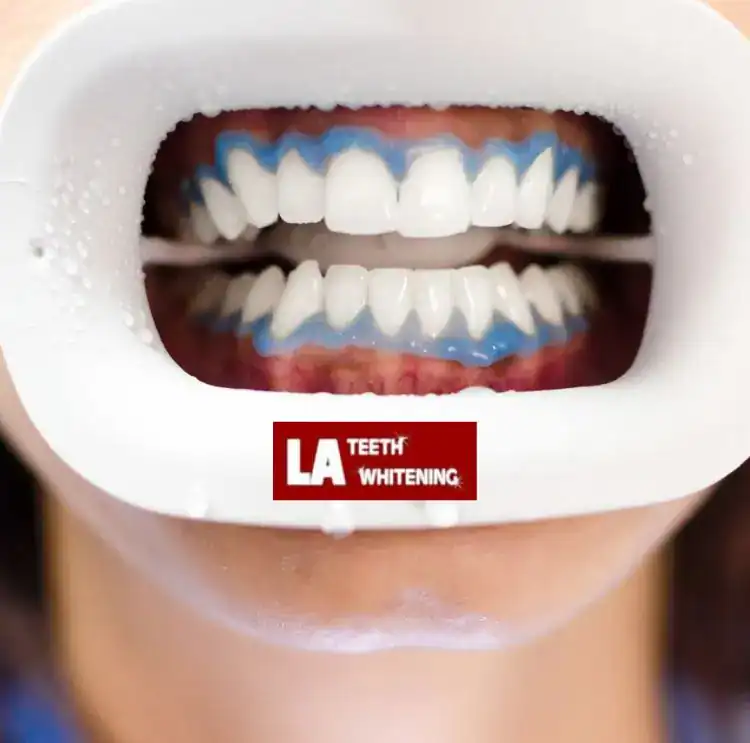 1 Hour Teeth Whitening Southend-on-Sea Southend on Sea