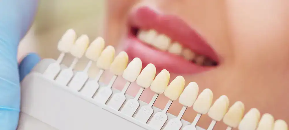 What If My Natural Teeth Become Whiter Than My Veneers or Crowns Southend on Sea