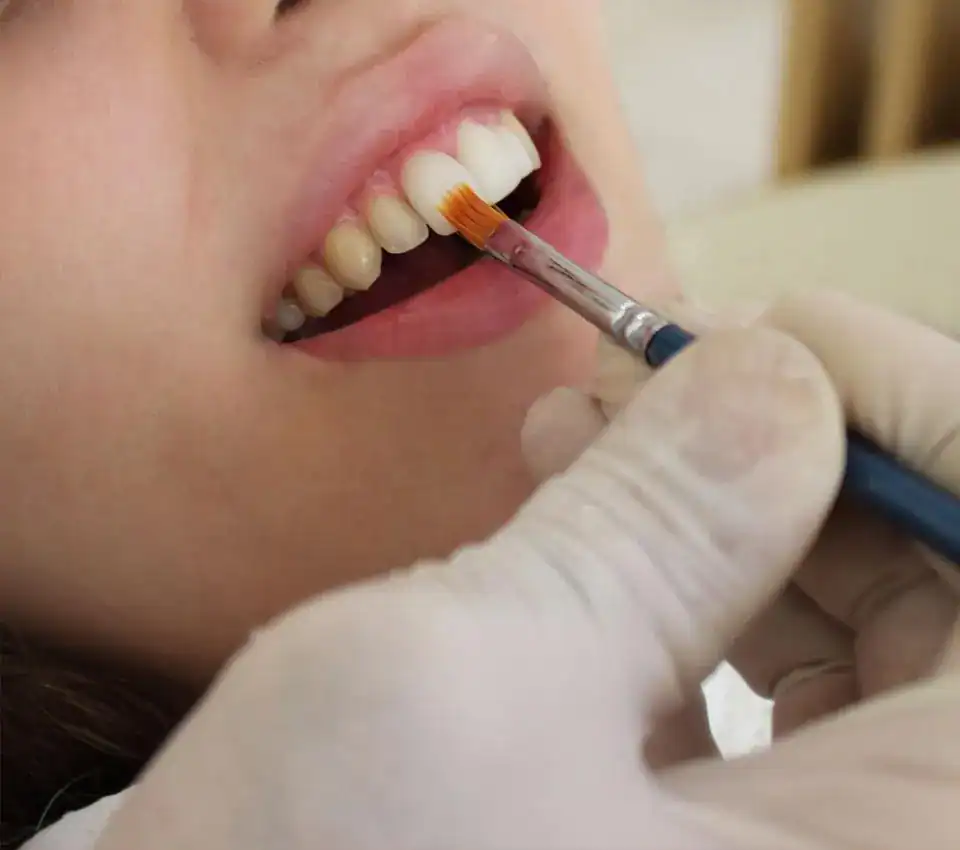 Can You Have Laser Teeth Whitening If You Have Crowns or Veneers Southend on Sea